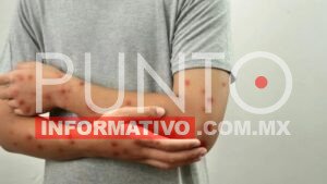 Oficial. Secretaría de Salud confirma el primer caso de Mpox subclado Ib en México; se detectó en un extranjero